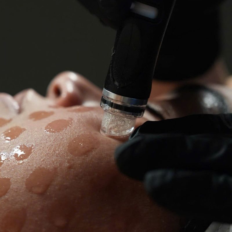aqua peel